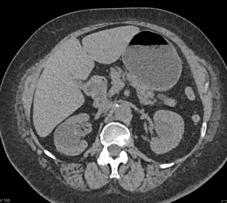 Bosniak 2F Right Renal Cyst - CTisus CT Scan