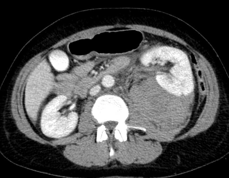 Left Renal Angiomyolipoma with Bleed - CTisus CT Scan