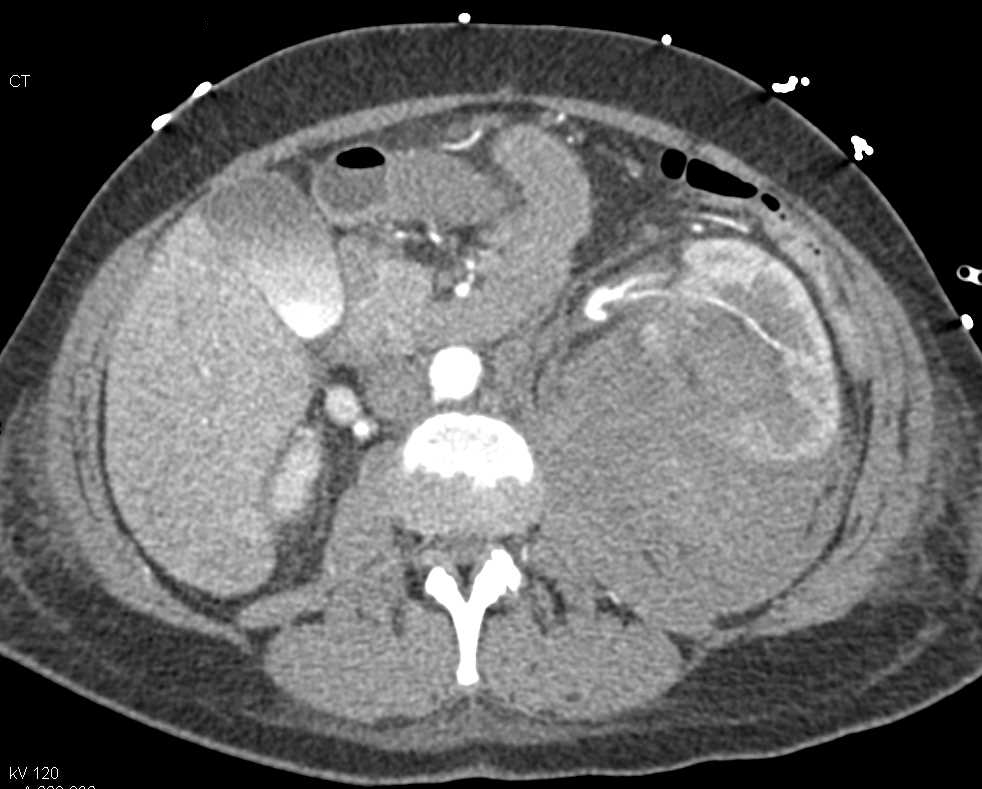 Left Renal Bleed from Aneurysm in Patient with an Angiomyolipoma (AML) - CTisus CT Scan