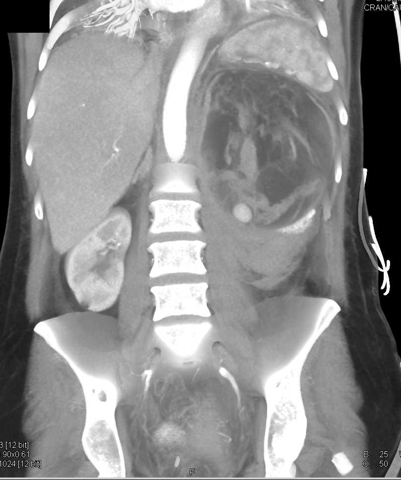 Left Renal Bleed from Aneurysm in Patient with an Angiomyolipoma (AML) - CTisus CT Scan