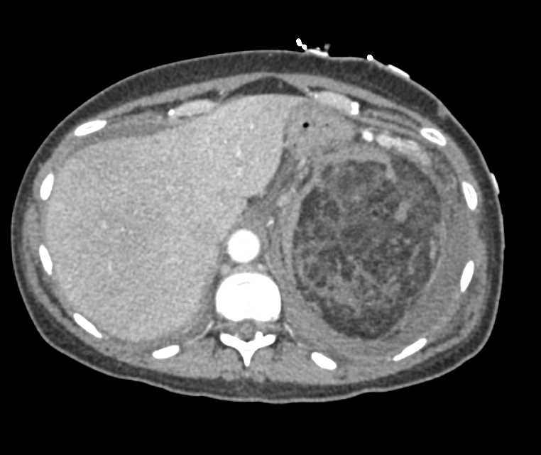 Left Renal Bleed from Aneurysm in Patient with an Angiomyolipoma (AML) - CTisus CT Scan