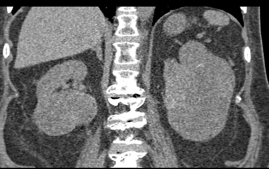 Bilateral Renal Cell Carcinoma - CTisus CT Scan