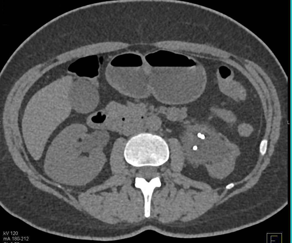 Transitional Cell Carcinoma Left Renal Pelvis and Extends in the Ureter - CTisus CT Scan