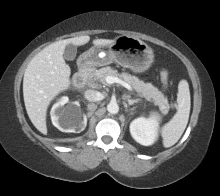 Transitional Cell Carcinoma Left Renal Pelvis and Adenopathy - CTisus CT Scan