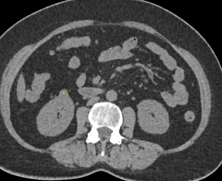 1cm Renal Cell Carcinoma which is Clear Cell RCC - CTisus CT Scan