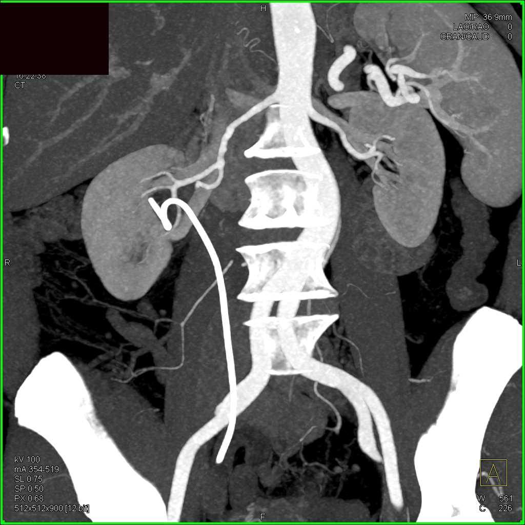 FMD Right Renal Artery with Stent in Right Renal Pelvis - CTisus CT Scan