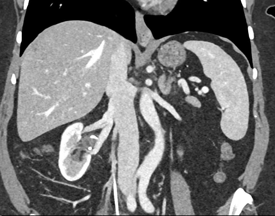 Fibromuscular Dysplasia (FMD) Right Renal Artery with Stent in Right Renal Pelvis - CTisus CT Scan