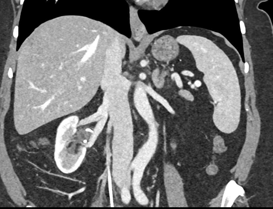 Fibromuscular Dysplasia (FMD) Right Renal Artery with Stent in Right Renal Pelvis - CTisus CT Scan