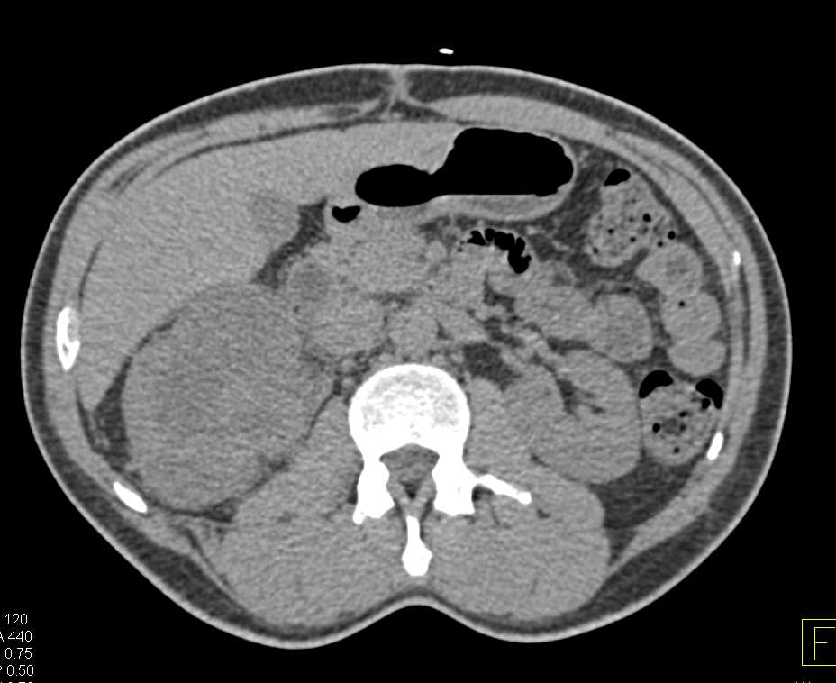 Renal Cell Carcinoma with Perirenal Spread in Right Kidney - CTisus CT Scan