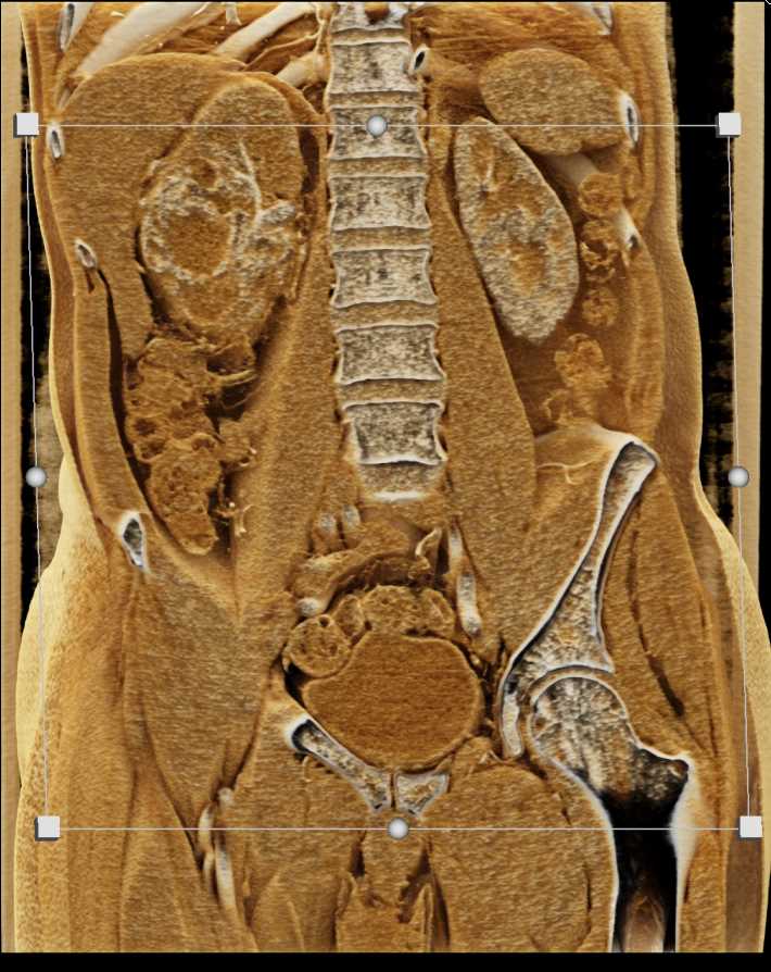 Renal Cell Carcinoma with Perirenal Spread in Right Kidney Using Cinematic Rendering - CTisus CT Scan