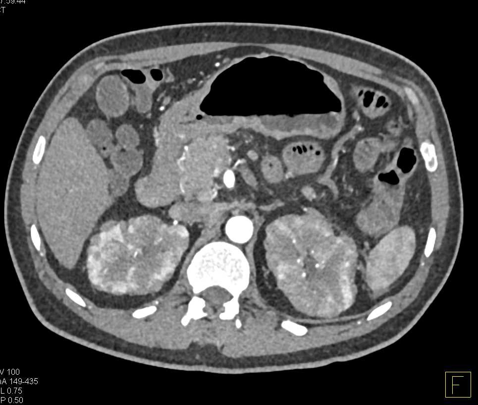 Lymphomatous Infiltration of the Kidneys - CTisus CT Scan