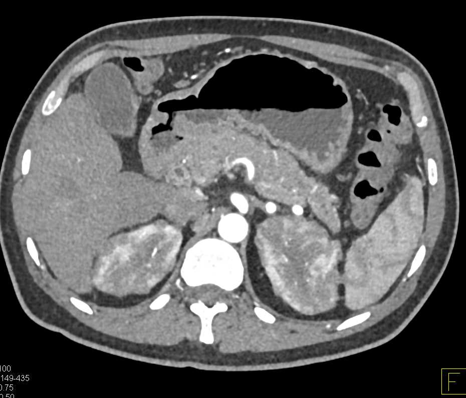 Lymphomatous Infiltration of the Kidneys - CTisus CT Scan