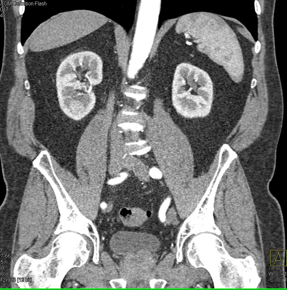 Incidental Papillary Right Renal Cell Carcinoma - CTisus CT Scan