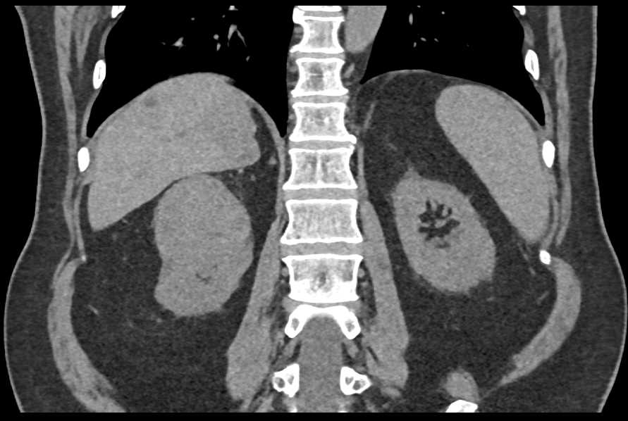 Papillary Renal Cell Carcinoma (RCC) - CTisus CT Scan