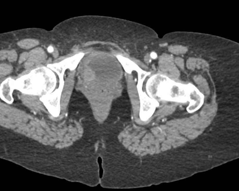 Carcinoma at Right Ureterovesical Junction (UVJ) - CTisus CT Scan