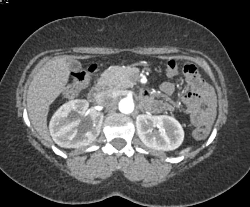 Carcinoma at Right Ureterovesical Junction (UVJ) - CTisus CT Scan