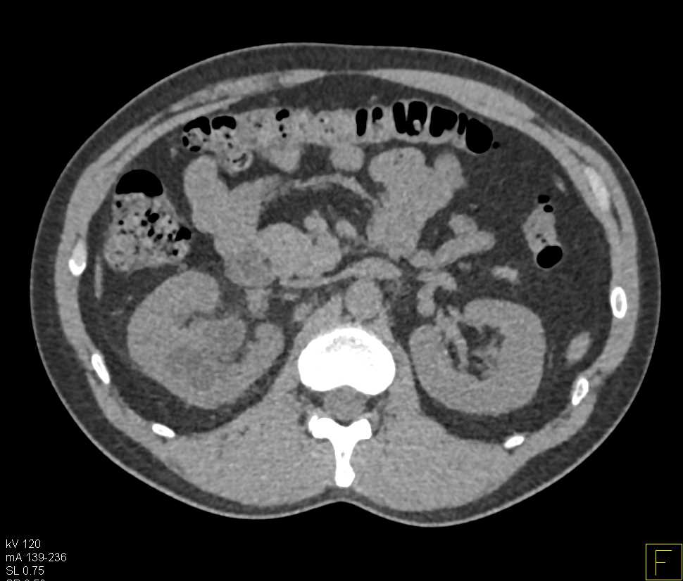 Transitional Cell Carcinoma Right Kidney - CTisus CT Scan