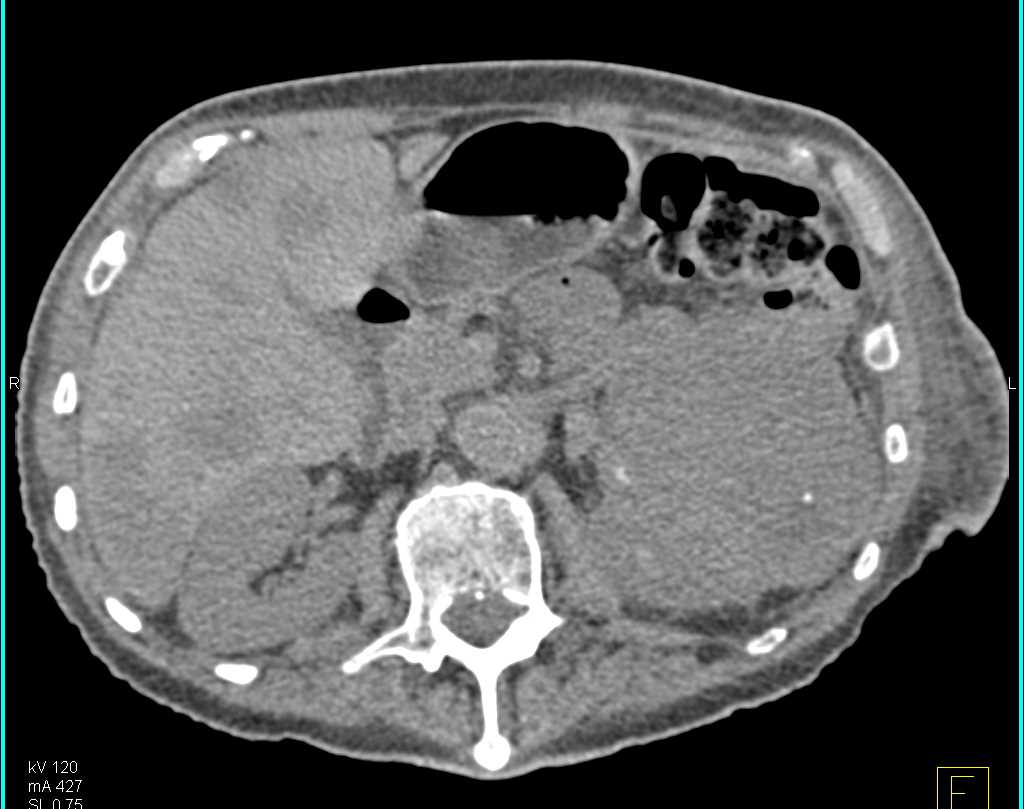 Renal Cell Carcinoma with Liver and Bone Metastases - CTisus CT Scan