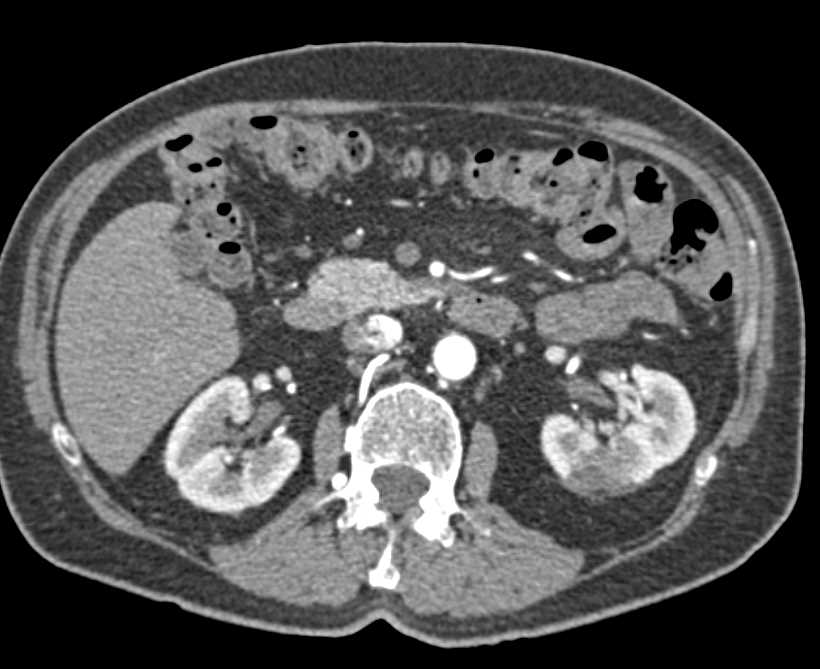 Left Renal Infarction - CTisus CT Scan