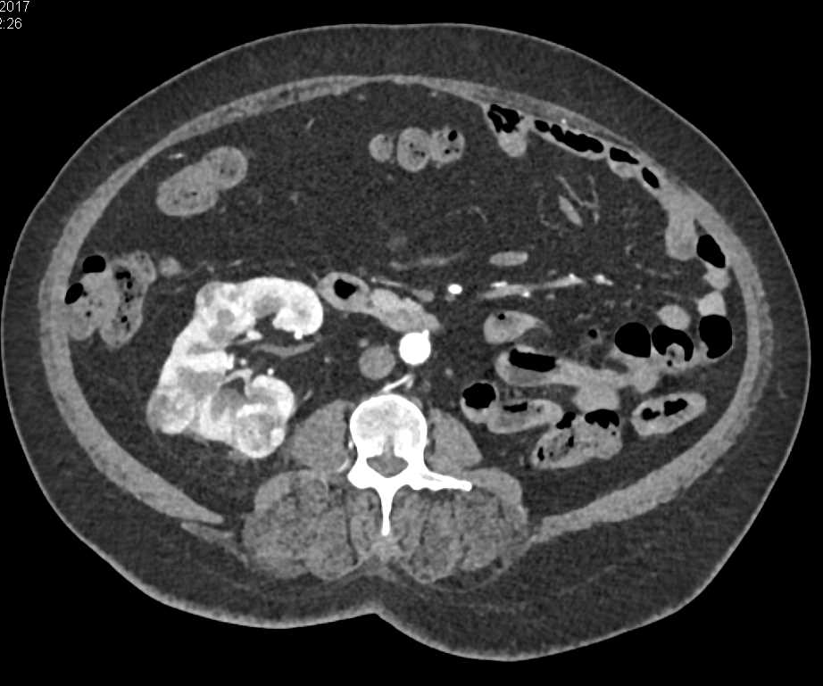Multiple Right Renal Cell Carcinomas in Patient with Von Hippel-Lindau Syndrome (VHL) Syndrome - CTisus CT Scan