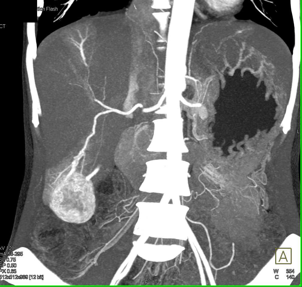 Metastatic Renal Cell Carcinoma - CTisus CT Scan