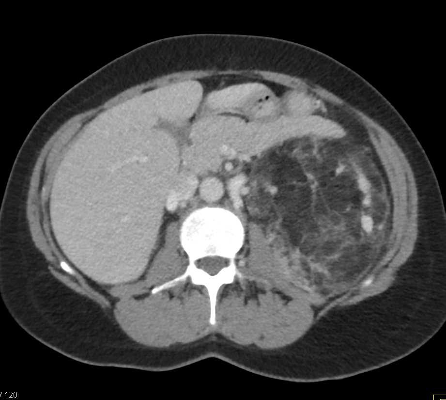 Large Left Renal Angiomyolipoma (AML) - CTisus CT Scan