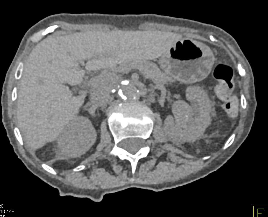 Transitional Cell Carcinoma (TCC) of the Left Kidney - CTisus CT Scan