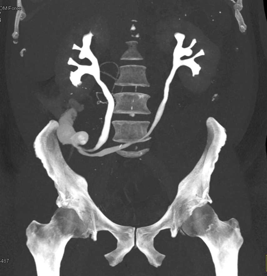 Ileal Loop with CT Urogram - CTisus CT Scan