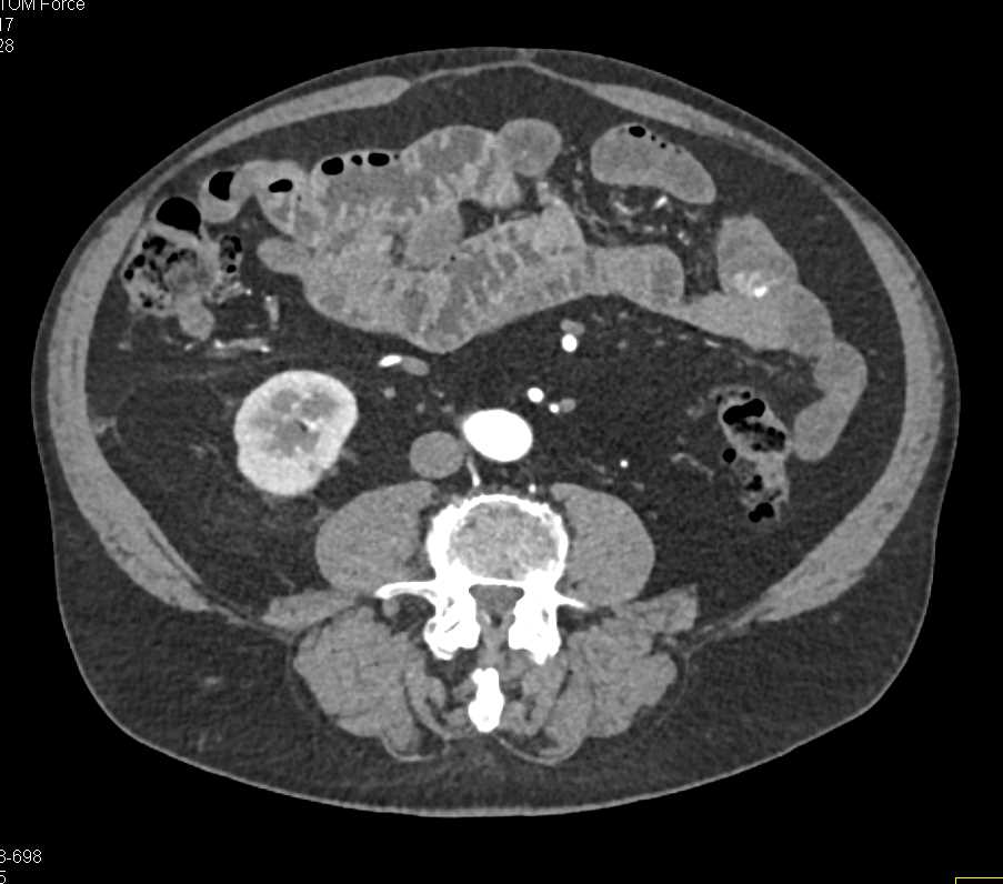 Metastatic Renal Cell Carcinoma to the Pancreas - CTisus CT Scan