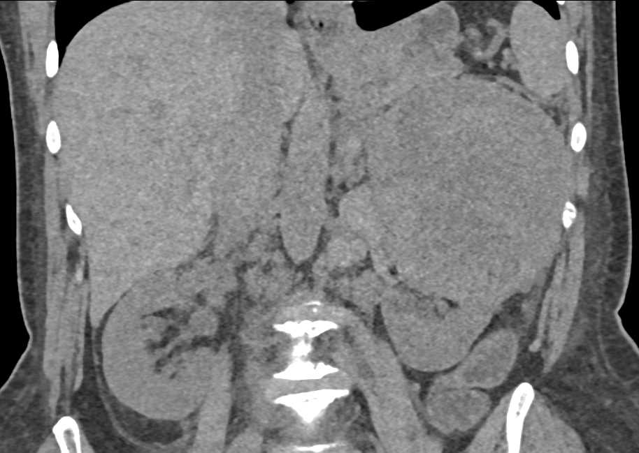 Necrotic Renal Cell Carcinoma Invades the Left Renal Vein and Inferior Vena Cava (IVC) - CTisus CT Scan