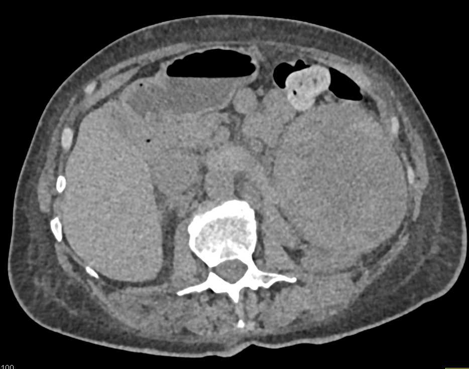 Necrotic Renal Cell Carcinoma Invades the Left Renal Vein and Inferior Vena Cava (IVC) - CTisus CT Scan