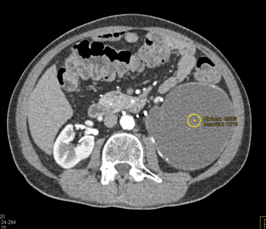 Bosniak 2 Cyst Left Kidney - CTisus CT Scan