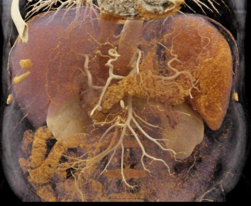 Cinematic Rendering of the Kidneys and Pancreas and Vascular Map - CTisus CT Scan