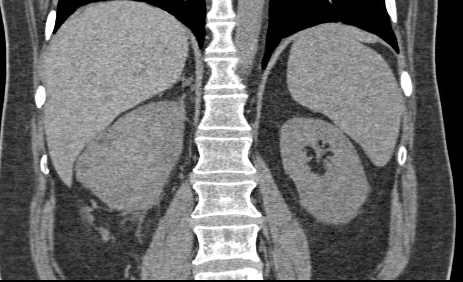 Papillary Right Renal Cell Carcinoma - CTisus CT Scan