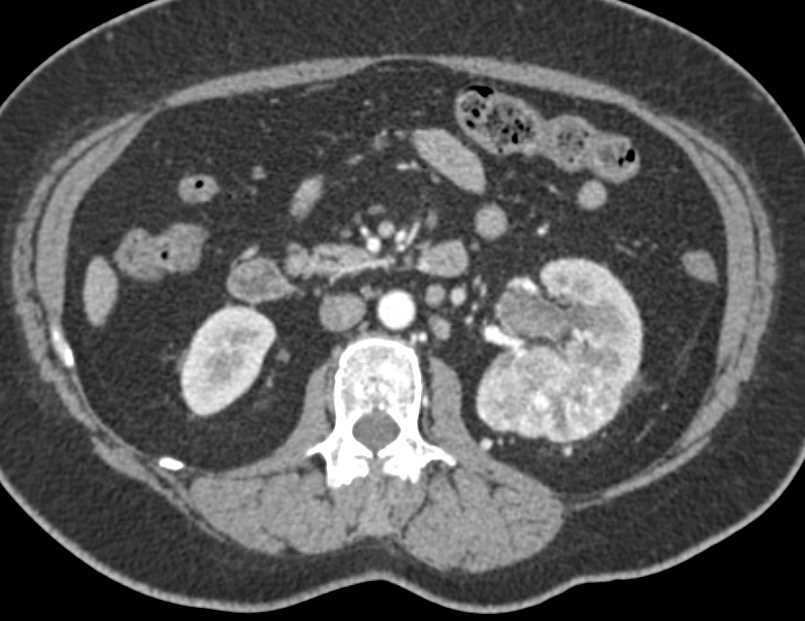 Clear Cell Renal Cell Carcinoma (CCRCC) Left Kidney - CTisus CT Scan