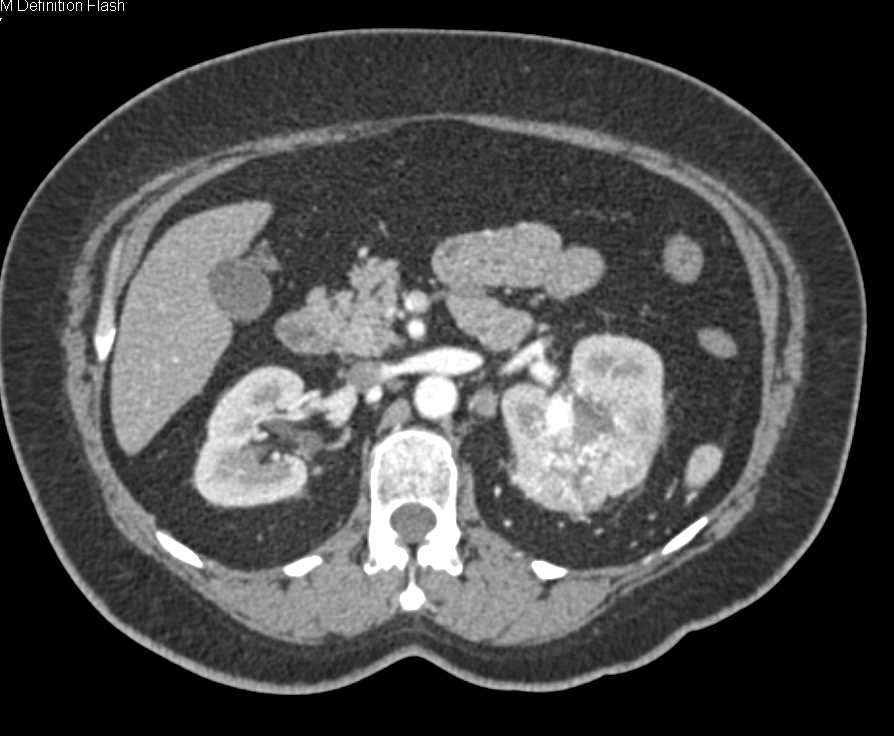 Clear Cell Renal Cell Carcinoma (CCRCC) Left Kidney - CTisus CT Scan