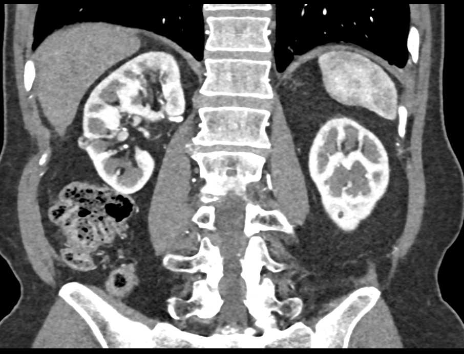 1cm Angiomyolipoma (AML) Right Kidney - CTisus CT Scan