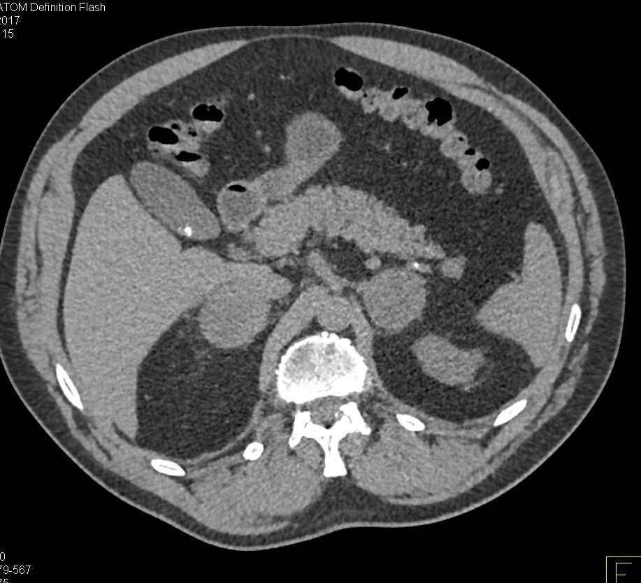 Bilateral Adrenal Metastases from Renal Cell Carcinoma - CTisus CT Scan