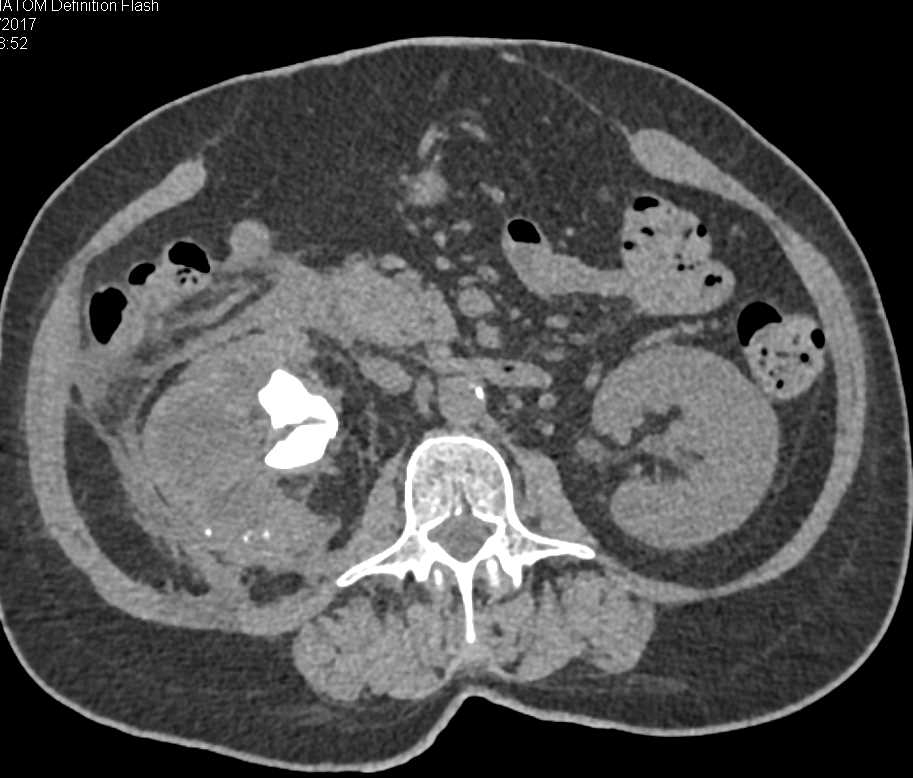 Xanthogranulomatous Pyelonephritis (XGP) Right Kidney - CTisus CT Scan