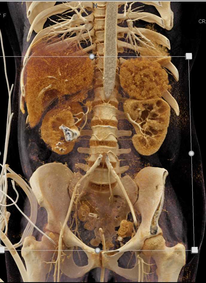 Xanthogranulomatous Pyelonephritis (XGP) Right Kidney with Cinematic Rendering - CTisus CT Scan