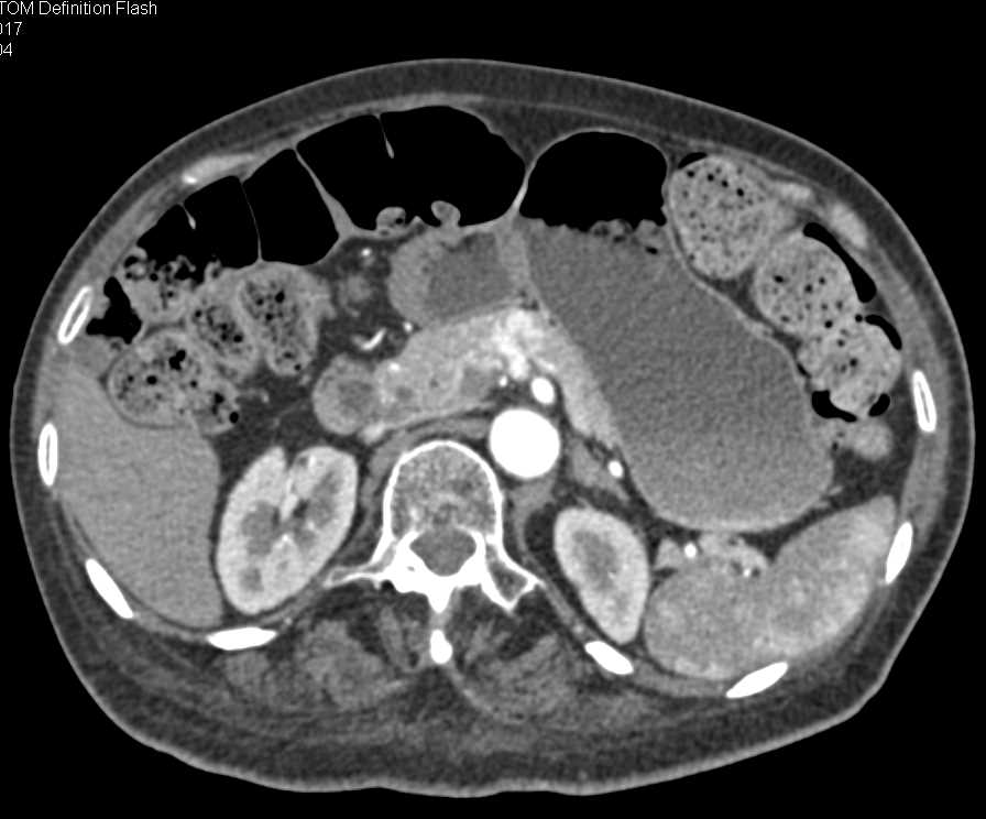 Metastatic Renal Cell Carcinoma to the Pancreas - CTisus CT Scan