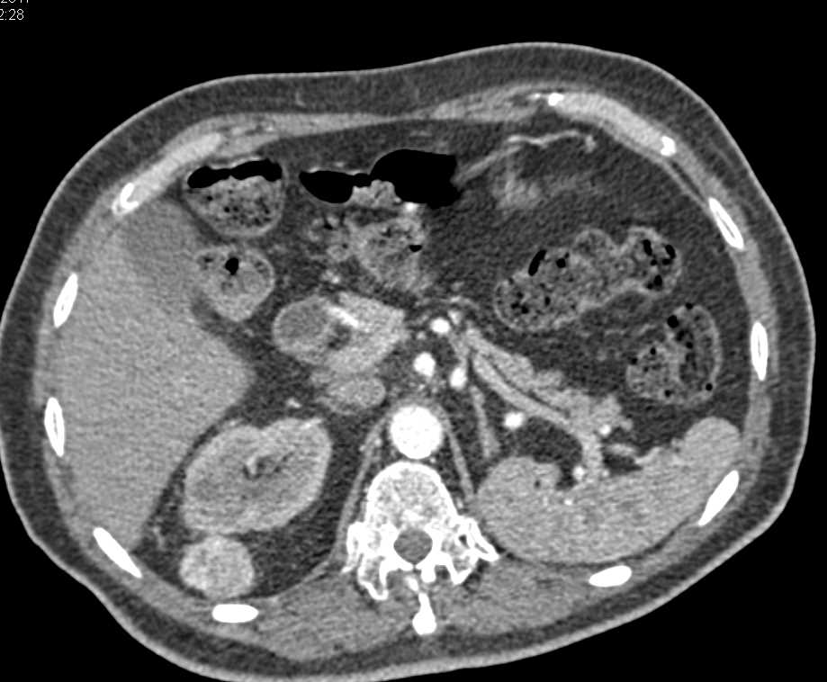 Renal Cell Carcinoma Metastatic to the Right Pararenal Space - CTisus CT Scan