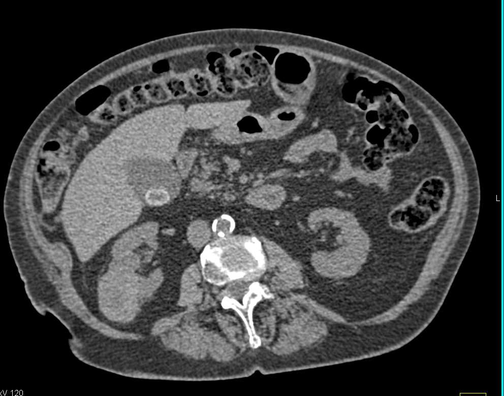 Clear Cell Renal Cell Carcinoma (CCRCC) Right Kidney - CTisus CT Scan