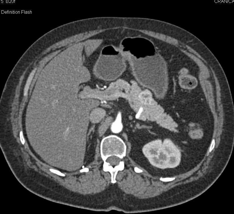 Metastatic Renal Cell Carcinoma to the Pancreas and Bone - CTisus CT Scan