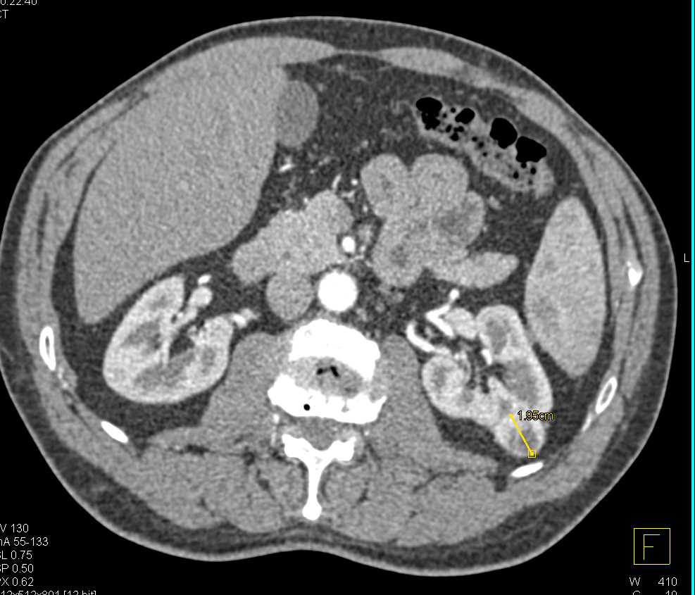 2cm Left Renal Cell Carcinoma - CTisus CT Scan