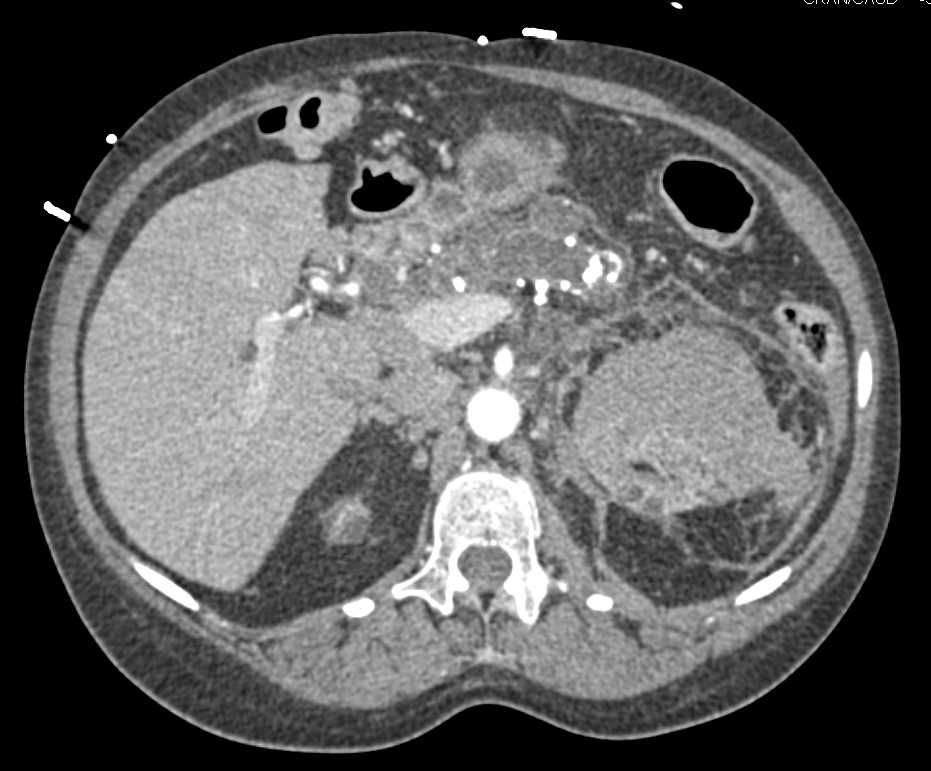 Cystic Renal Disease with Left Perirenal Hematoma as well as Chronic Pancreatitis - CTisus CT Scan