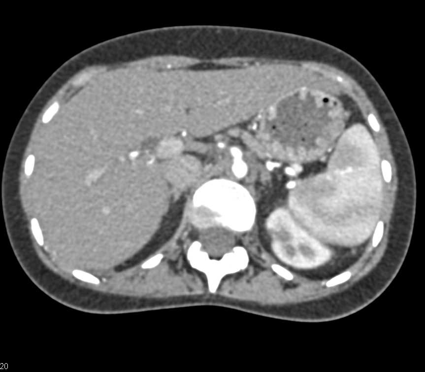 Multiple Renal Infarcts - CTisus CT Scan