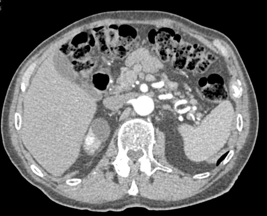 Multiple Blood Clots in the Left Renal Pelvis - CTisus CT Scan