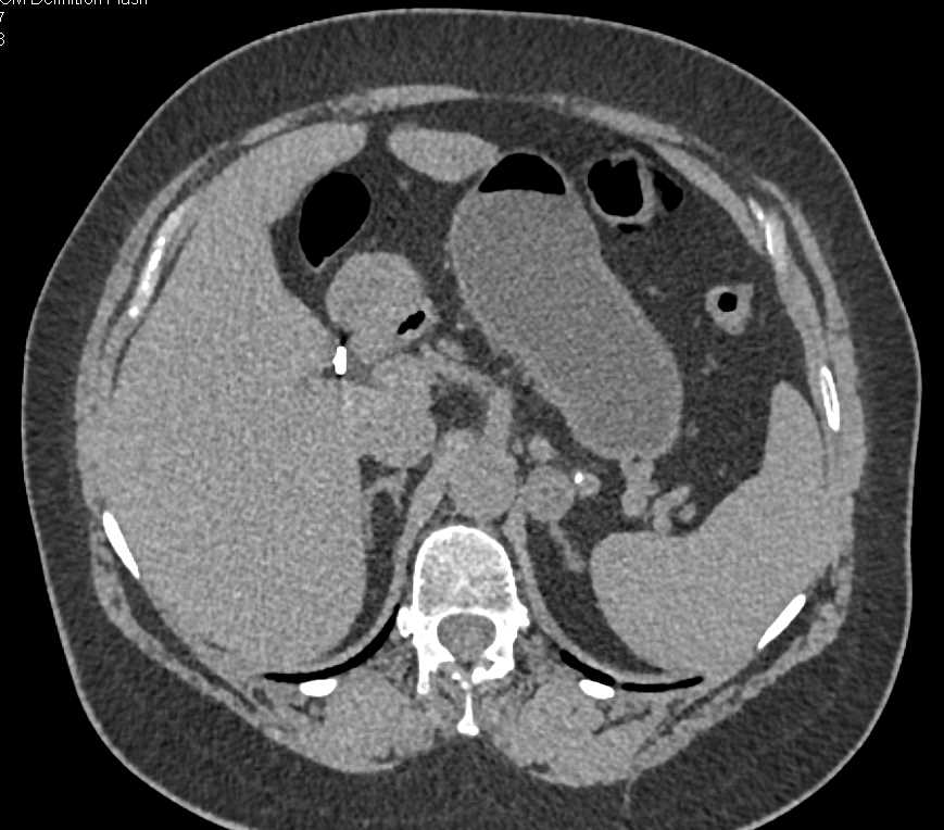 Right Adrenal Myelolipoma - CTisus CT Scan