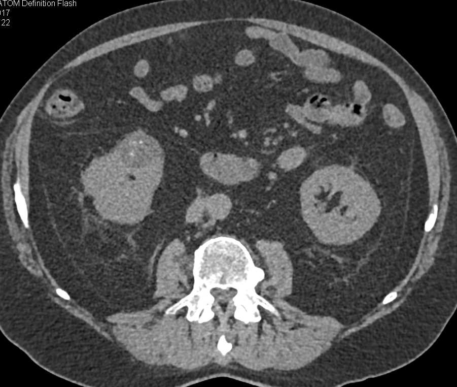 Bosniak 2F Cyst Right Kidney - CTisus CT Scan